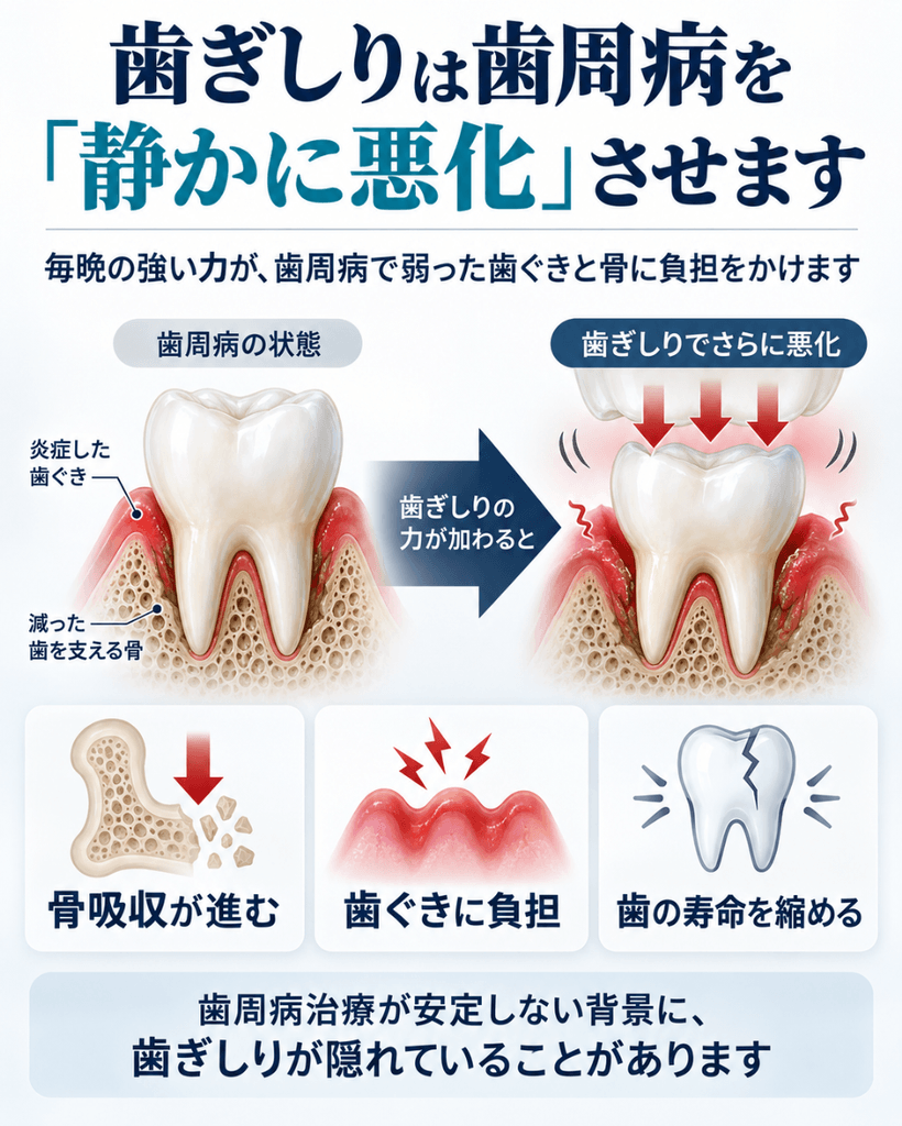 歯ぎしりが歯周病を悪化させる仕組みを示す図。歯周病で弱った歯ぐきと骨に毎晩の強い力が加わると、骨吸収が進み、歯ぐきに負担がかかり、歯の寿命を縮めることを図解