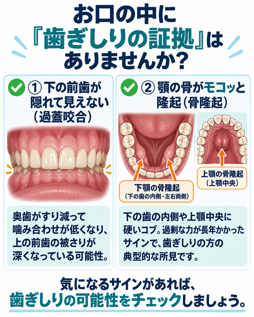 歯ぎしりの証拠となるお口のサインを示す図。①奥歯のすり減りで上の前歯の被さりが深くなる過蓋咬合、②下の歯の内側や上顎中央にできる硬いコブ（骨隆起）を解説
