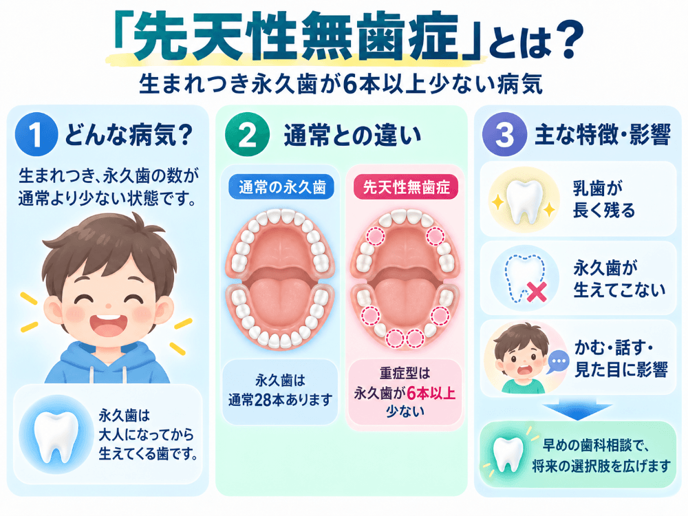 生まれつき永久歯が6本以上少ない重症型先天性部分無歯症をやさしく説明するイラスト