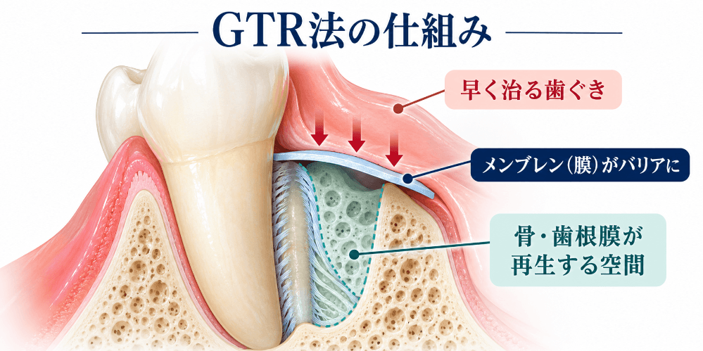 GTR法の仕組みの図解:骨の欠損部をメンブレン(膜)で覆い、早く治る歯ぐきの入り込みを防いで、骨や歯根膜が再生する空間を確保する