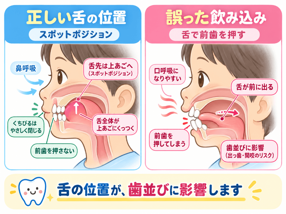正しい舌の位置(スポットポジション)と誤った飲み込み方の違いを示した図