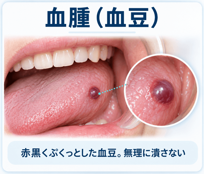 口腔内の血腫（血豆）。舌にできた赤黒くぷくっとした豆で、無理に潰さない