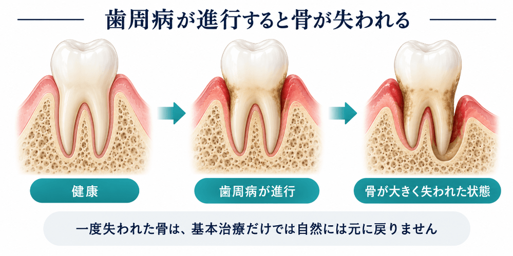 歯周病が進行すると骨が失われる様子の図解:健康な状態から、歯周病の進行とともに歯を支える骨(歯槽骨)が大きく失われていく3段階。一度失われた骨は、基本治療だけでは自然には元に戻らない