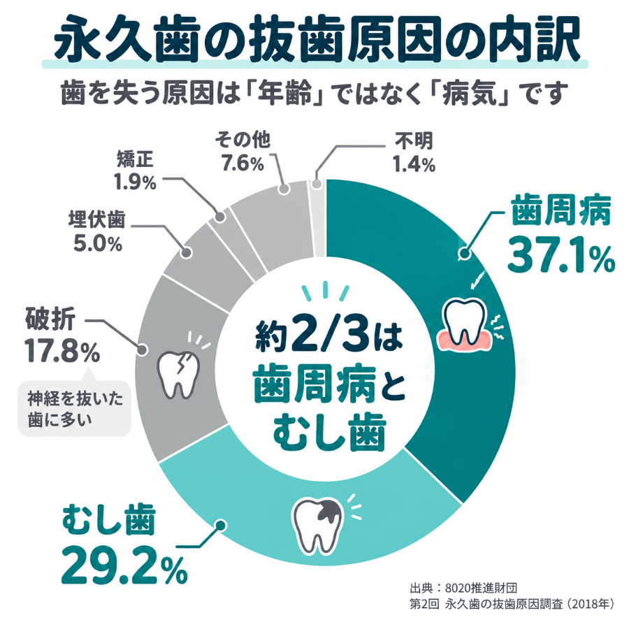 永久歯の抜歯原因の内訳を示すドーナツグラフ。歯周病37.1%、むし歯29.2%、破折17.8%で、歯周病とむし歯が約3分の2を占める(8020推進財団 第2回永久歯の抜歯原因調査)