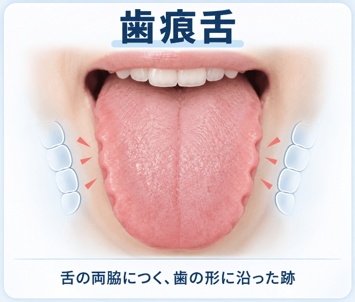 歯痕舌。舌の両脇に歯の形に沿ってついた波状のギザギザの跡