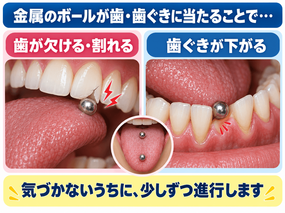 舌ピアスの金属ボールが歯や歯ぐきに当たり、歯の破折と歯肉退縮を起こす様子を示した図解