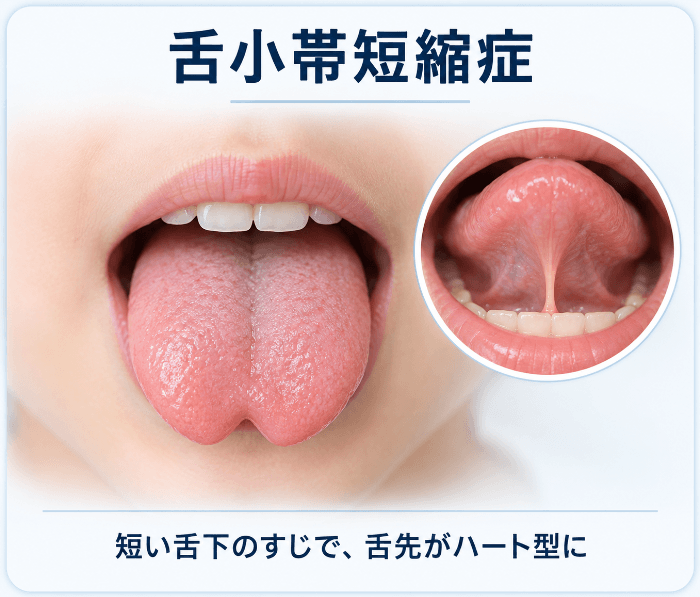 舌小帯短縮症。舌の裏のすじが短く、舌を前に出すと舌先がハート型にくびれる