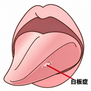 舌にこすっても取れない境界明瞭な白い板状の病変ができた白板症のイラスト