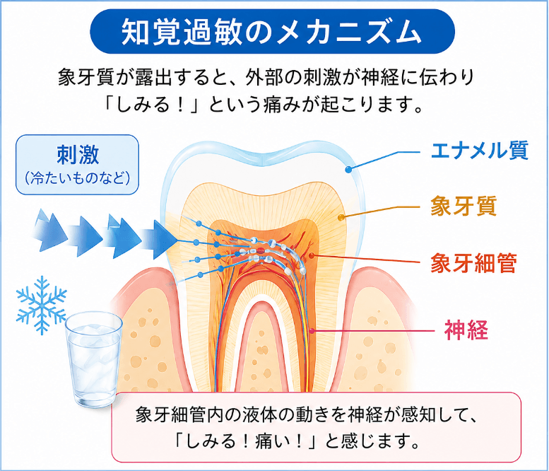 知覚過敏のメカニズムを示す図解|象牙質が露出し冷たい刺激が象牙細管を通って神経に伝わる仕組み