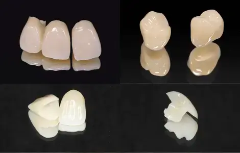 セラミック修復物の例-前歯と奥歯の被せ物、e-maxインレー