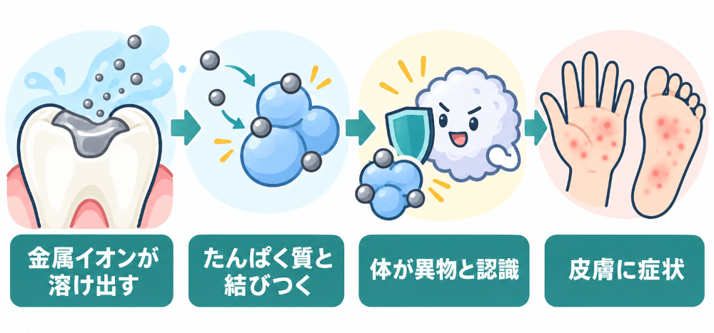 銀歯から溶け出した金属イオンが体内でアレルギー反応を起こすまでの流れを示した図