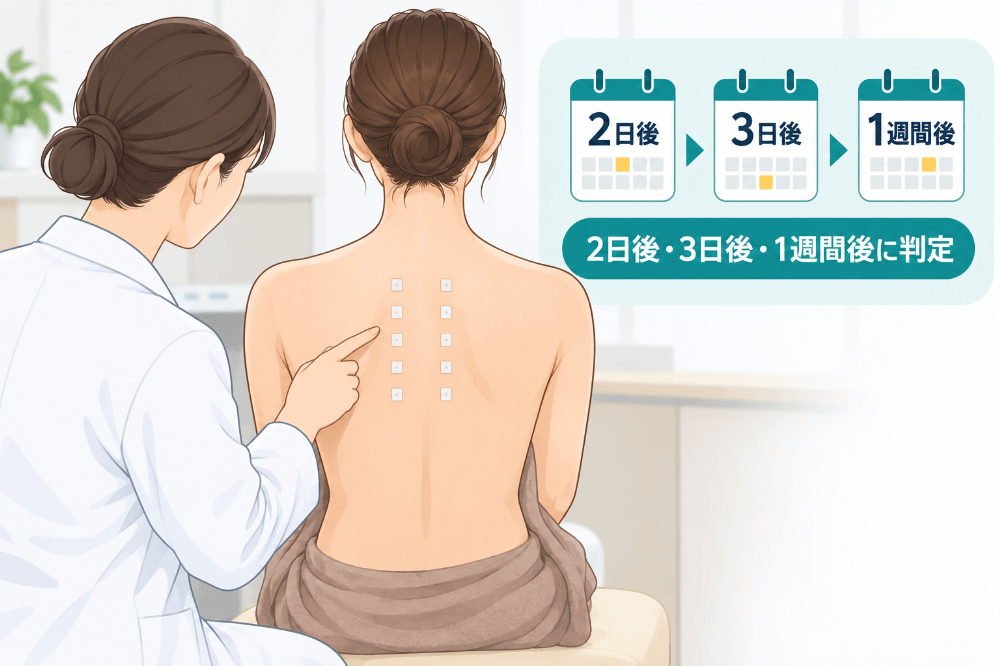 背中に金属の試薬を貼って皮膚の反応を調べるパッチテストのイラスト