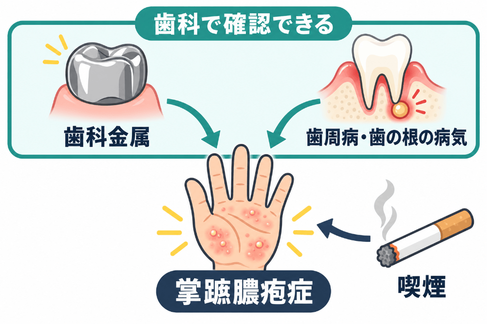 掌蹠膿疱症を悪化させる要因として、歯科金属・歯周病や歯の根の病気・喫煙の3つを示した図